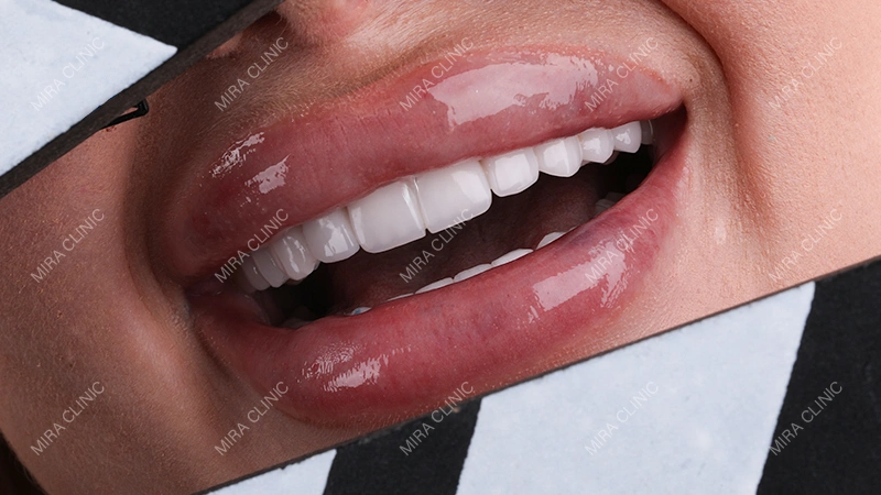 veneers dental tourism